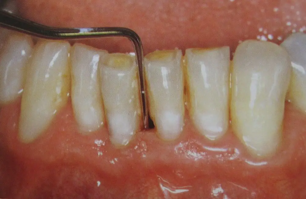 Periodontitis